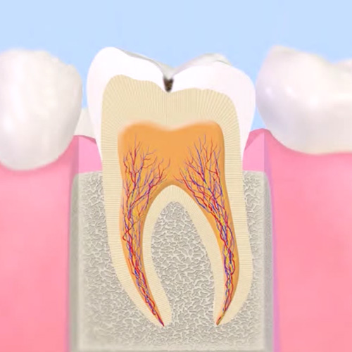 エナメル質が溶け始めた初期のむし歯（C1）の断面イラスト