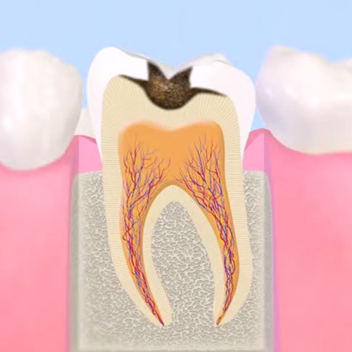 象牙質まで穴があいた進行したむし歯（C2）の断面イラスト