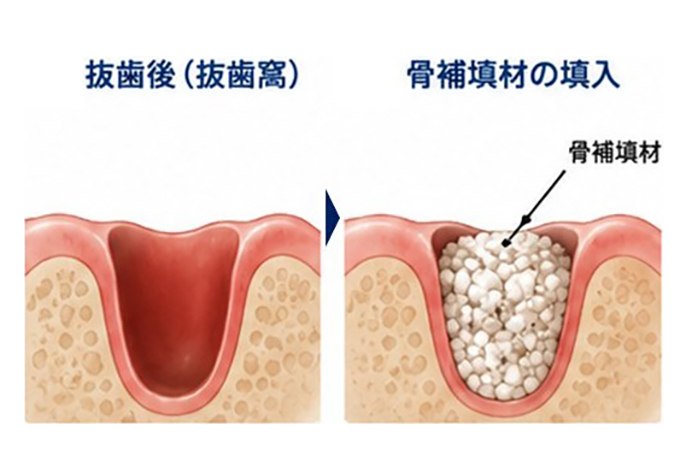 ソケットプリザベーション（抜歯窩温存術）